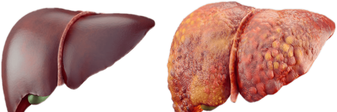 【同济医生说】杨长青:肝脏疾病什么时候会变成肝硬化?