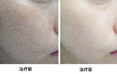 祛斑对比图_360图片