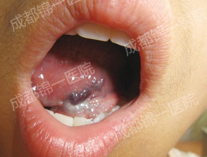 【口腔血管瘤的症状图解与治疗】