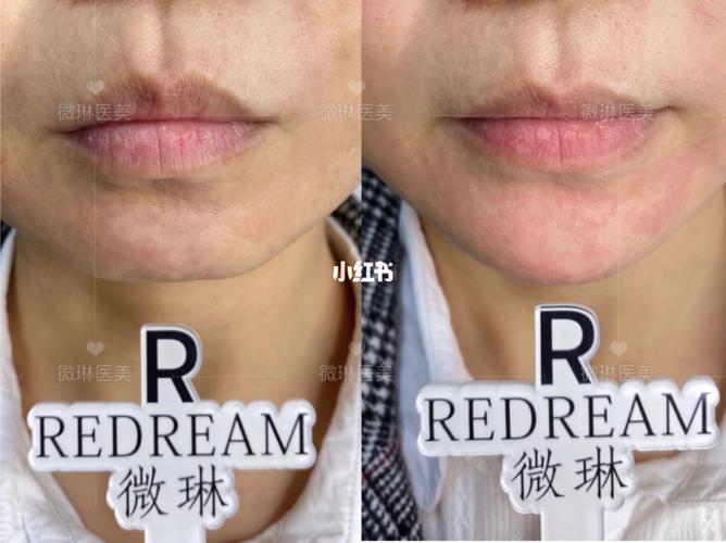 下巴凹陷 下巴填充 后缩_玻尿酸_玻尿酸下巴_美妆_医