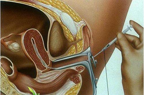 ivf(广州试管婴儿)胚胎移植