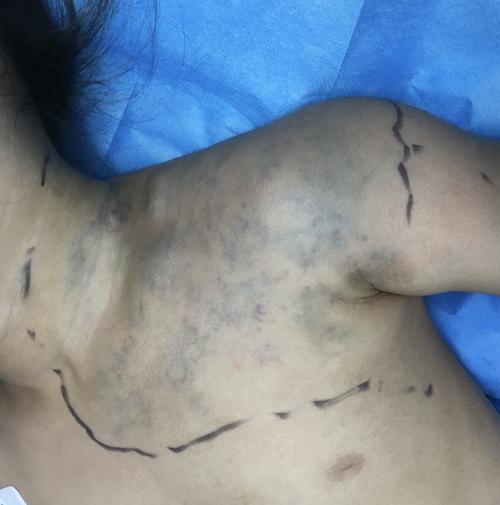 儿童血管畸形静脉畸形医学科普