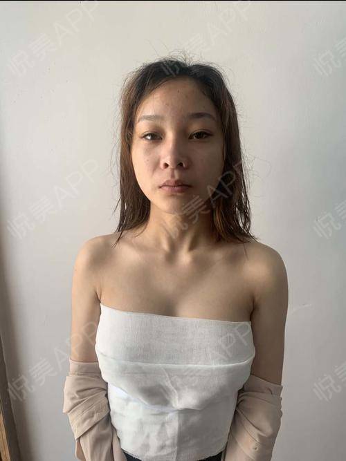 【自体脂肪丰胸术后5天】