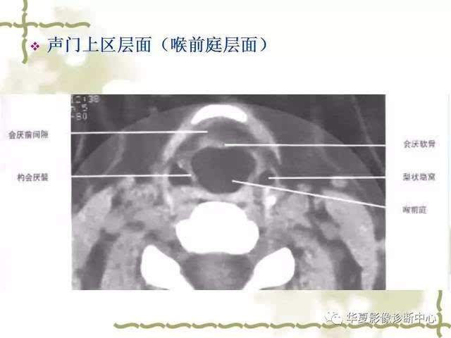 【影像基础】喉部解剖及各型喉癌的ct表现简记