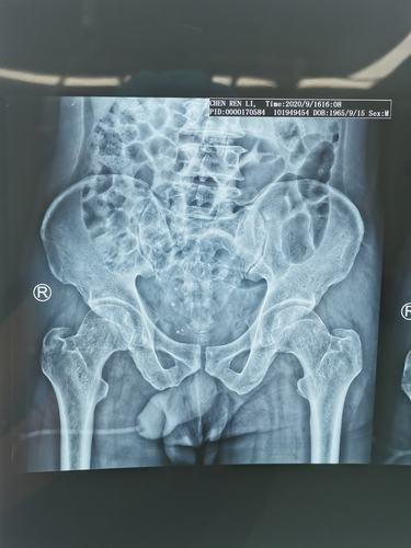 右侧骶骨翼骨折2.右侧骶髂关节脱位3.耻骨联合分离4.