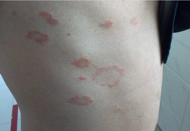 了肝癌切除手术后,病情就稳定下来了,两周后陈先生身上的红斑开始奇迹