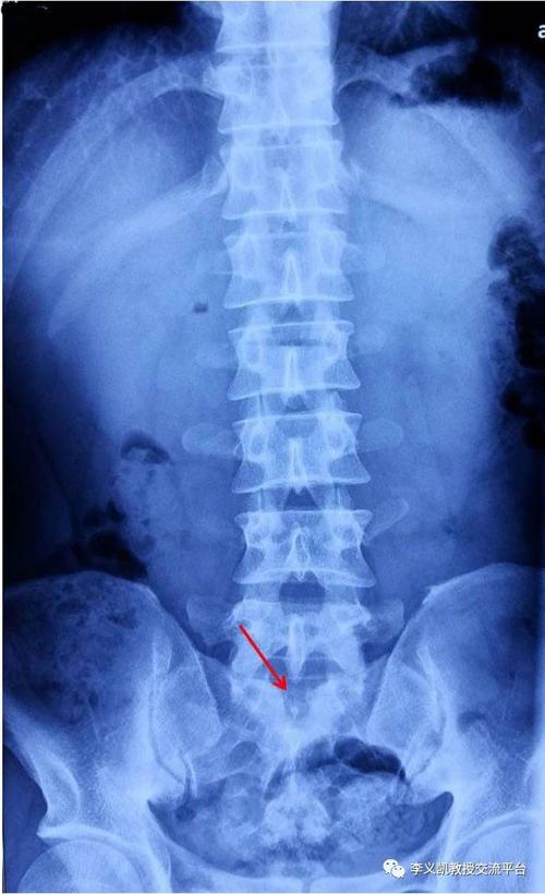 骶椎隐裂加浮棘