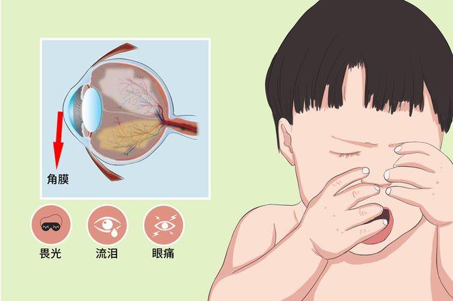 儿童角膜炎的症状
