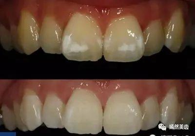 氟斑牙又称斑釉牙,是儿童在七,八岁前牙齿发育时期人体摄入的氟含量