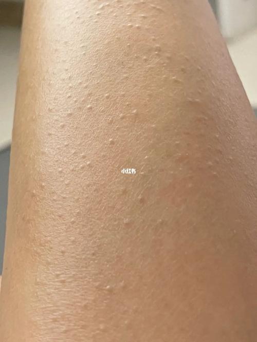 毛周角化_鸡皮肤_毛周角化_皮肤病_身体乳_刷酸_鸡皮肤毛周角化症_美