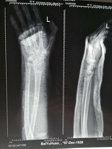 老年人最容易摔伤的一种骨折～～桡骨远端骨折,一般发生在雪雨天气