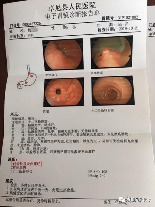 2019年10月17日,胃镜示:慢性浅表性胃炎伴糜烂增生;病理检查报告示