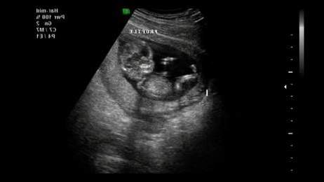 怀孕3个月的彩超影像,最后箭头指示这是个男宝宝