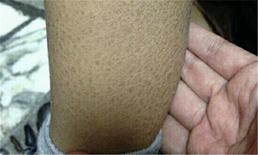 小腿轻微鱼鳞病图片