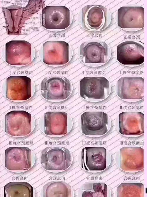 宫颈糜烂的演变过程_宫颈糜烂_癌症_医疗健康_医疗