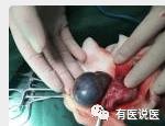 11岁男孩睾丸扭转360°,紫得像葡萄,最终被切除…只因家长忽略了这个