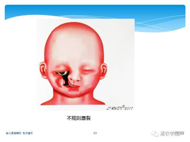 【超声微课堂】胎儿颜面部畸形超声诊断思路:中孕期唇裂和唇腭裂