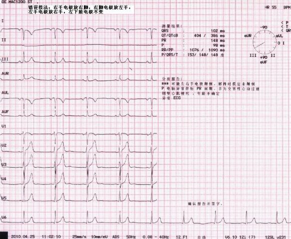 这份图如果用右位心无法解释胸导联心电图,如果用左右手反接,又不是