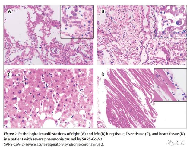 病毒性肺炎的影像学表现