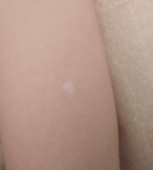 如果是白斑病一般多久会扩散开呢