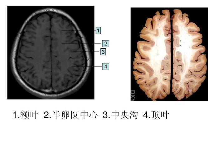 半卵圆中心