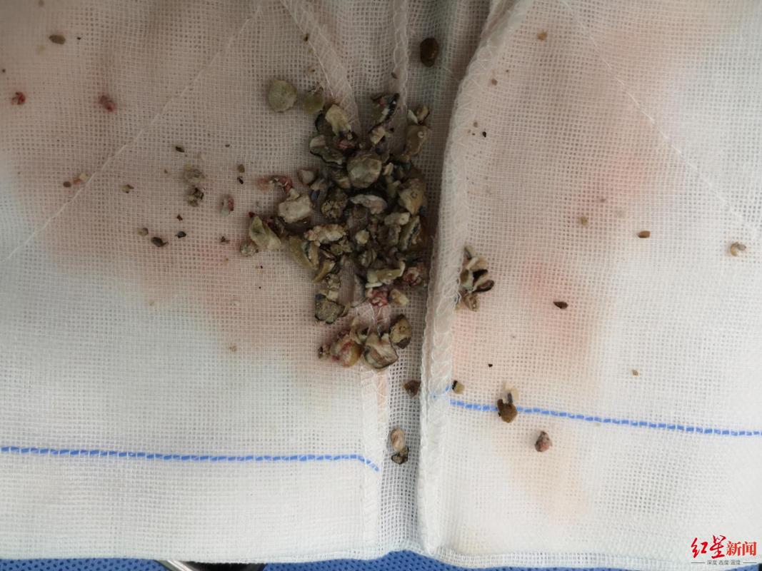 6月龄男婴输尿管下段被结石堆满这是怎么回事