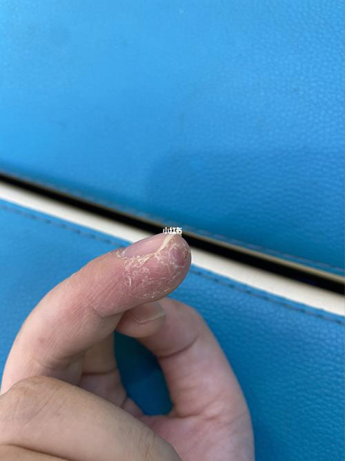 手指脱皮_医疗健康