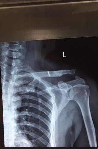 肩锁关节脱位如何固定