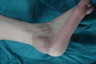 专治滑膜炎医院如何选择呢