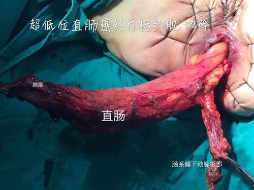 腹腔镜下直肠癌tme操作,游离到直肠内括约肌平面,会阴部行括约肌间