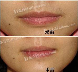              激光脱唇毛手术对比