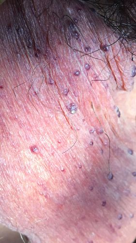 拉开看到是在皮下毛细血管上的. 阴囊血管上结的小血块是什么原因?