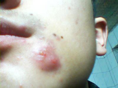 重度痤疮结节囊肿型