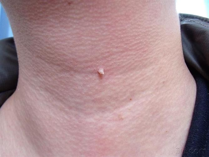 寻常疣--门诊照片