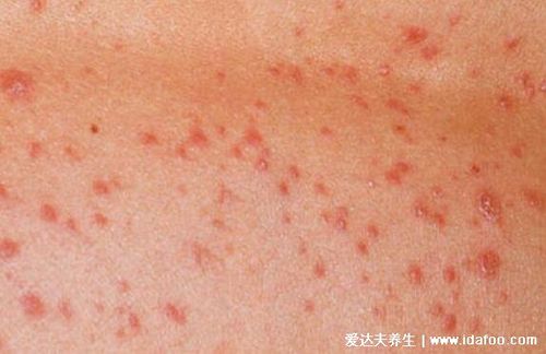 白血病初期小红点图片多为颜色鲜红针尖状红点