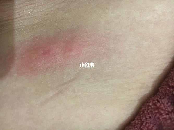 红疹子  荨麻疹_荨麻疹_药店_出水_止痒_医疗健康