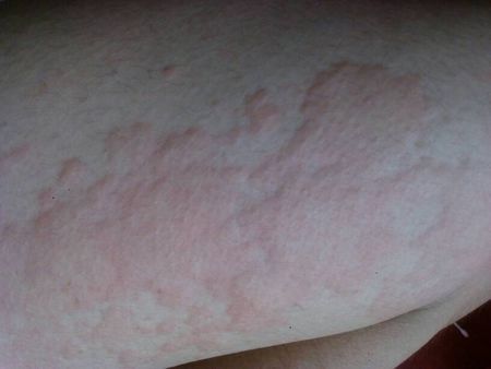 身上长了小红包,很痒.一挠就变成一片片的红疙瘩!还会扩散,那是什么!