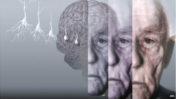 调查称英国人害怕得老年痴呆症 比癌症更甚