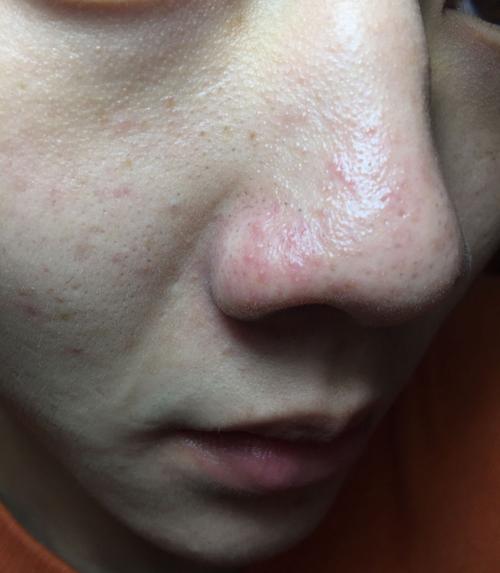 突然间鼻子上长了好多又是痘痘又像白头的东西,密密麻麻的好恐怖啊,我