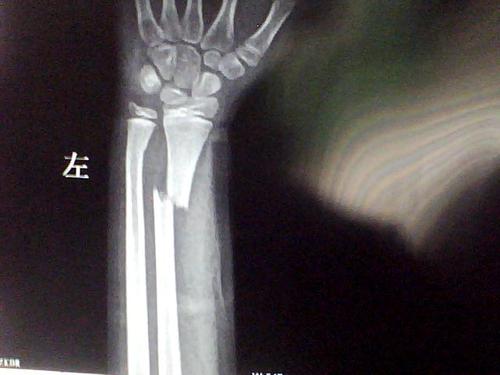 左手桡骨错位骨折
