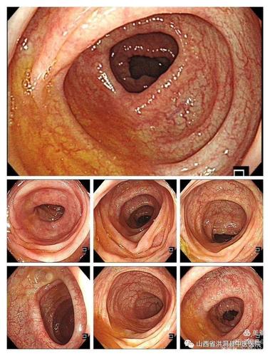 两月后病变部位肠镜下表现
