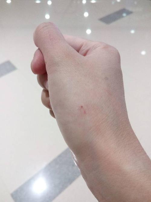 急急急,被流浪猫抓了一下,要打针吗