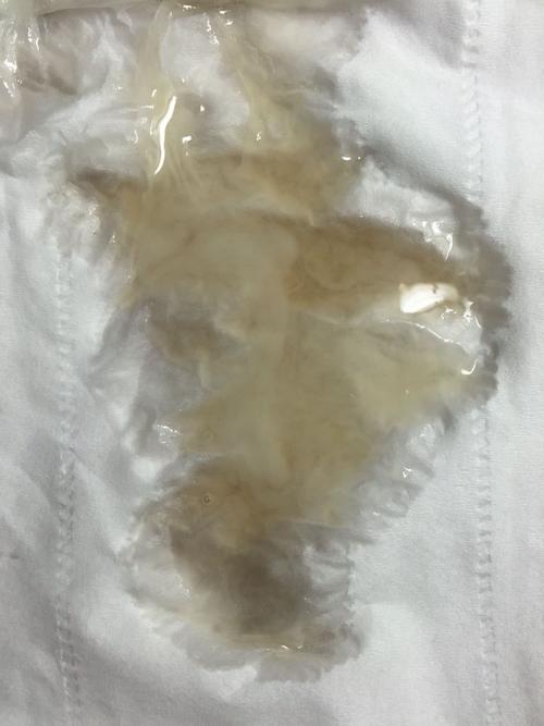 请问我的精子是不是正常的?谢谢!