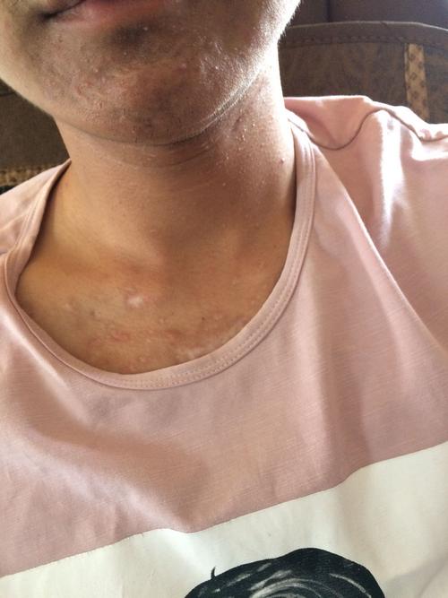 胸口以前受伤留了很多疤颜色白白的狠难看我是男人又挺爱面子怎么让