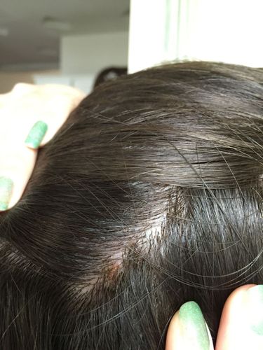 漂了头发后发现头皮长了很多一大坨鼓起来像结痂一样硬硬的,红红的又