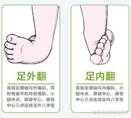 崴脚——踝关节扭伤