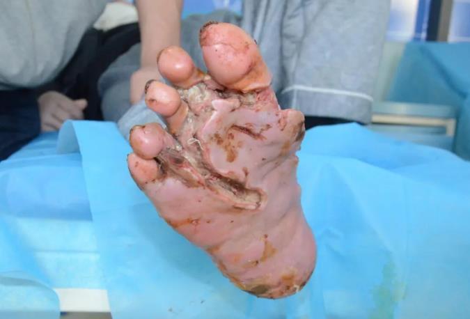 初步治疗后伤口肉芽长势良好