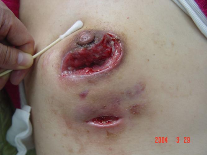 浆细胞性乳腺炎治愈图片