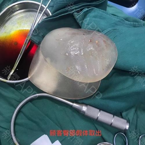 苗春来今日案例分享假体丰臀修复手术