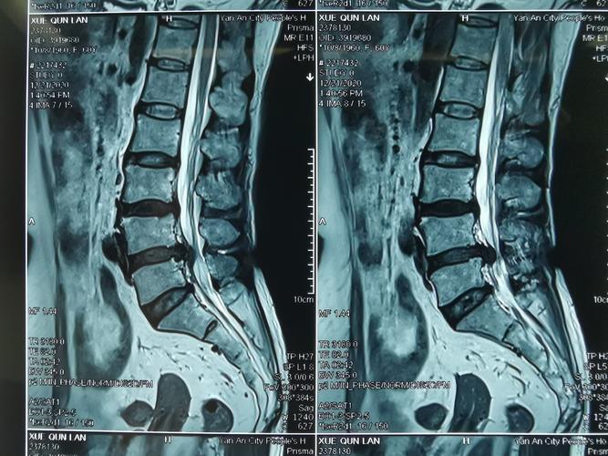 椎间孔镜技术(钥匙孔手术key-hole)治疗腰椎间盘突出症
